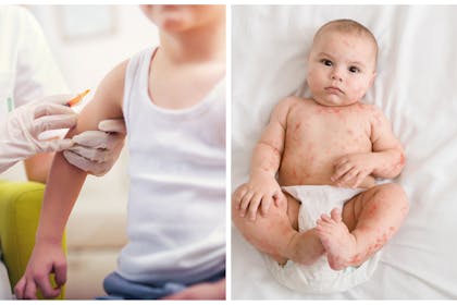 Left: a boy getting a vaccinationRight: a baby with measles 