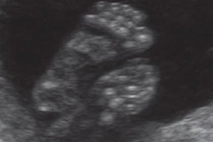21 weeks pregnant scan