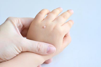 Adult hand holding child's hand with a wart