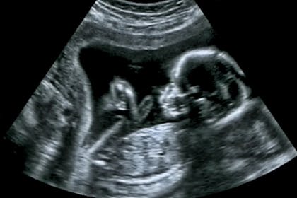 Baby scan