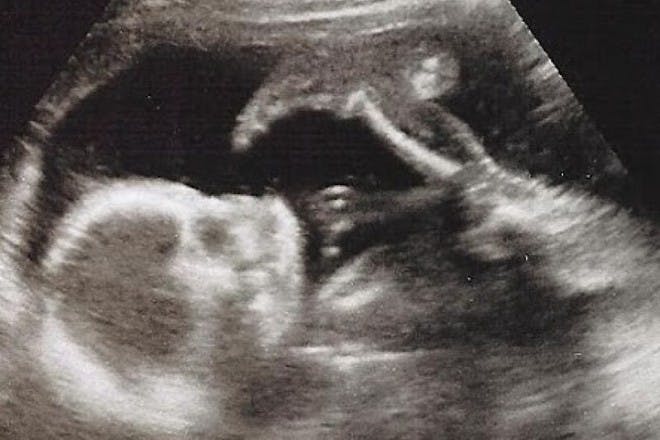 scan of baby