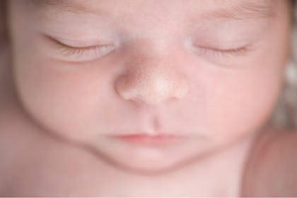 Young baby with milia spots