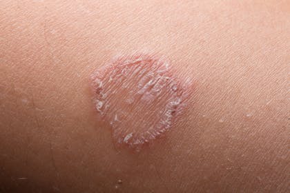 Close up of ringworm rash