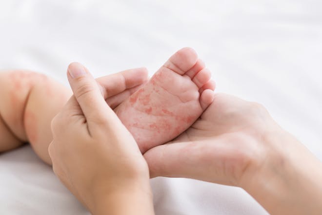 Measles on baby foot