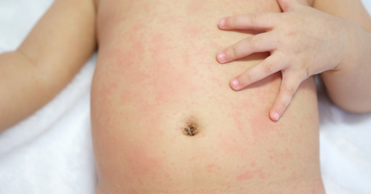 Rashes In Babies And Children What s My Child s Rash Netmums