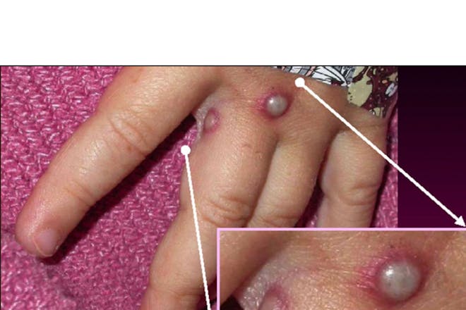 Hand with monkeypox pustules