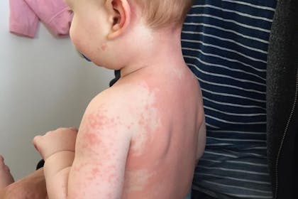 PIMS Kawasaki-like rash on toddler Alexander Parsons