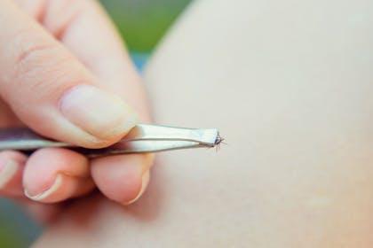 removing tick with tweezers