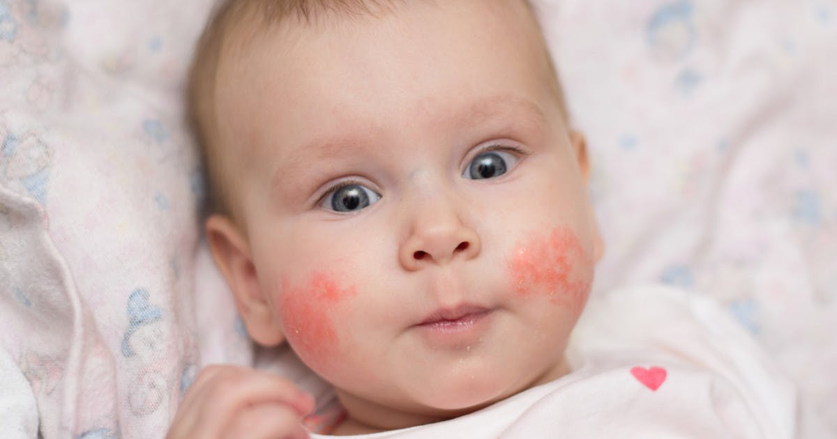 eczema-in-babies-and-children-netmums