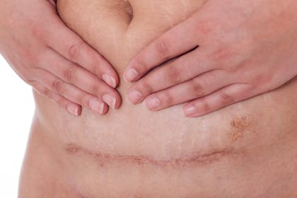 Why Is My C-section Scar Itchy? — Expecting & Empowered