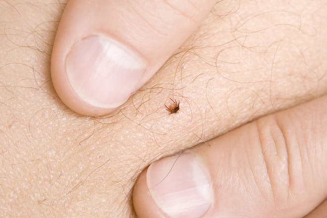 small burrowed tick on skin with thumbs for comparison