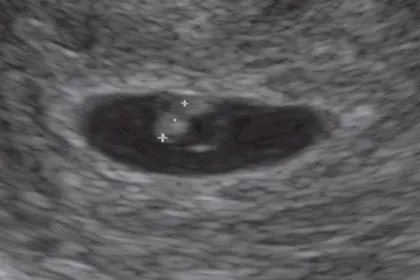6 Week Scan Week-by-Week Pregnancy Scan Photos Weeks 4-40 - Netmums