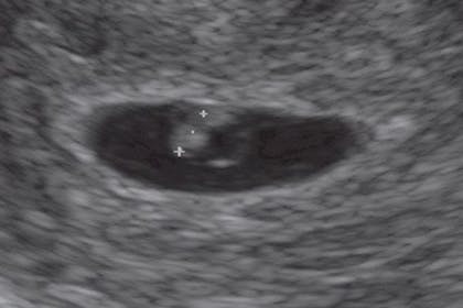 6 weeks pregnant scan