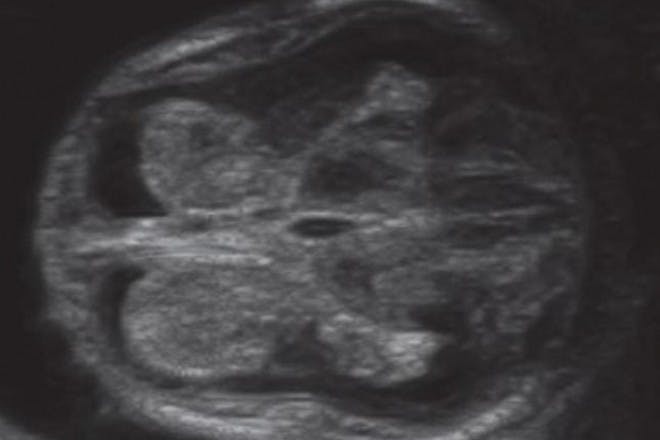 13 th week pregnancy scan