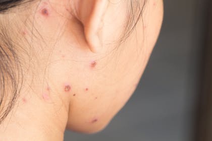 Chickenpox scabs and scars