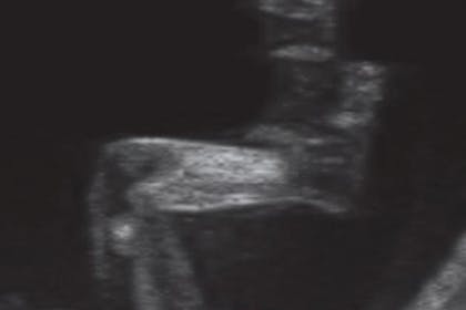 11 weeks pregnant scan