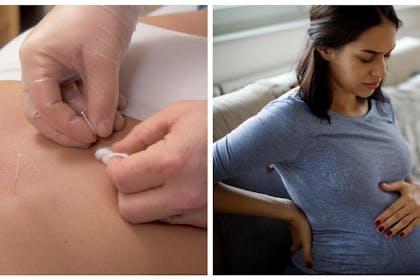 Needles being inserted into lower back | Pregnant woman experiencing back pain