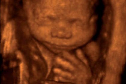 17 weeks pregnant scan