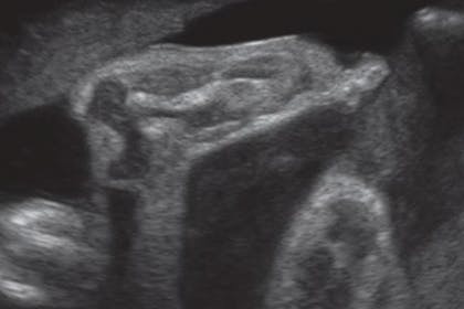 29 weeks pregnant scan