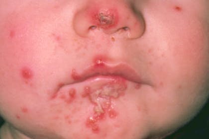 18. Impetigo