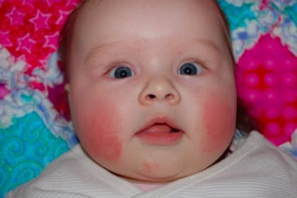 20. Teething rash