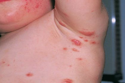 16. Scabies