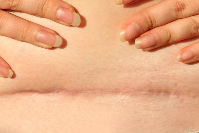 Picture of a C-section scar about a year after surgery