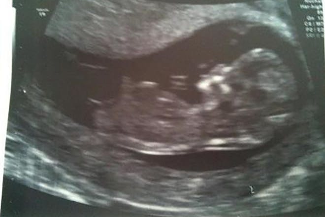 Photo of 12 week pregnancy anomaly scan