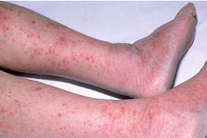 1. Meningitis rash