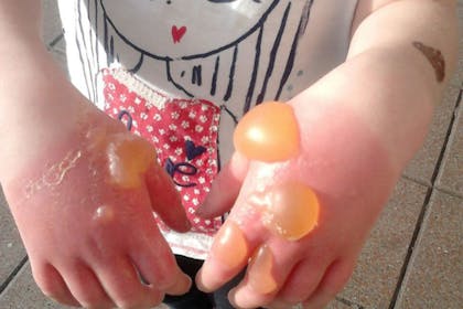 Child hands with giant blisters from hogweed