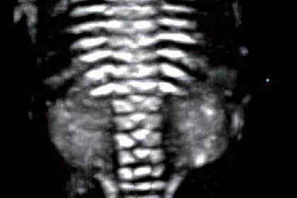 25 weeks pregnant scan