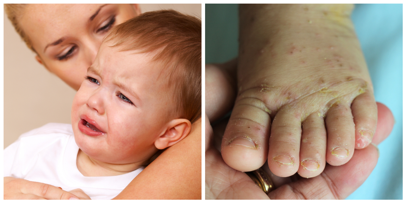 Parents urged to watch out for symptoms of scabies as cases of skin ...