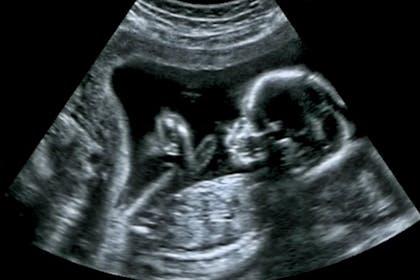 Baby fetus in pregnancy scan