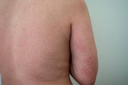 Rubella (German measles) rash