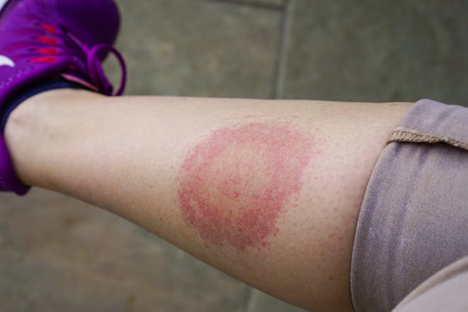 Circular tick bite rash for lyme disease