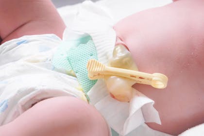 A picture of a newborn baby's umbilical cord clamped.