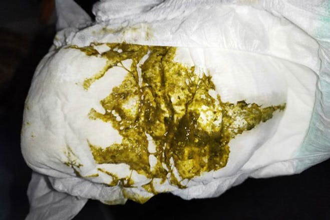 Baby Poop Green With White Chunks