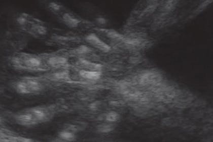 18 weeks pregnant scan