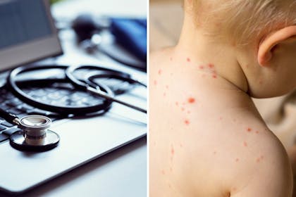 GP surgery. / child with measles rash