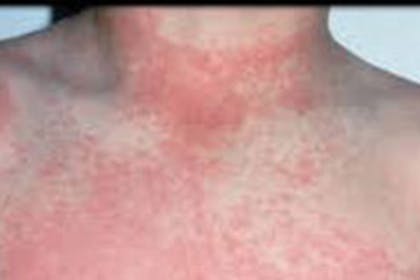 scarlet fever rash