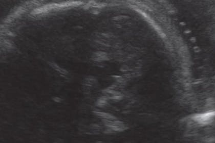 35 weeks pregnant scan