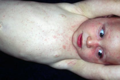 21. Roseola