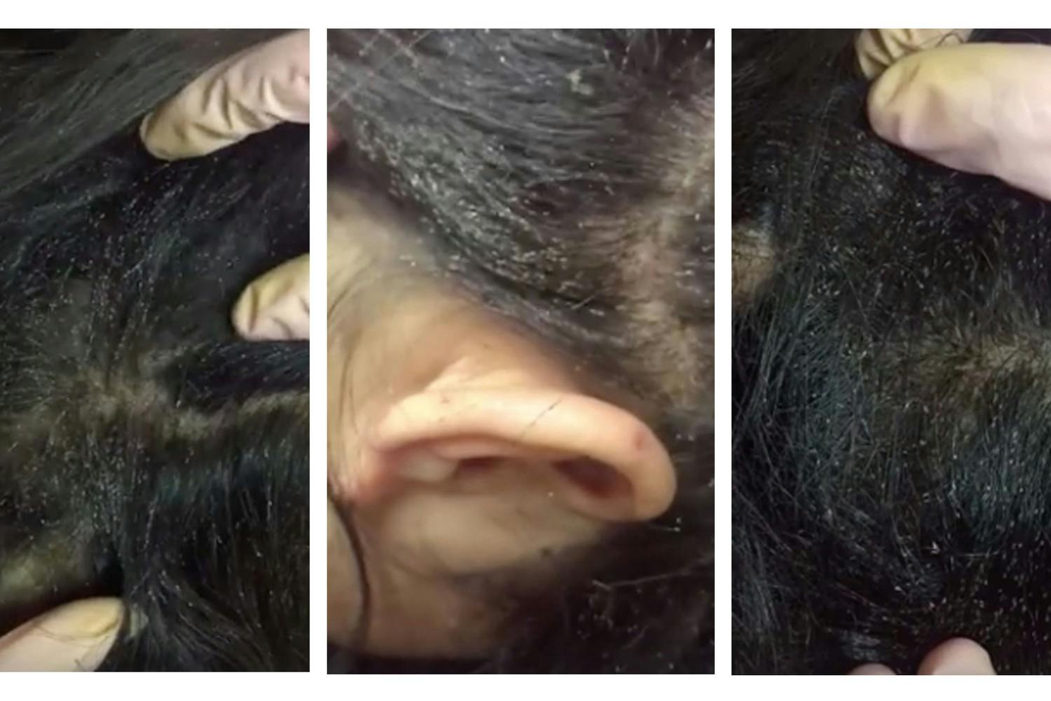 Mum Shares Video Of Daughter S Head Lice Infestation Netmums