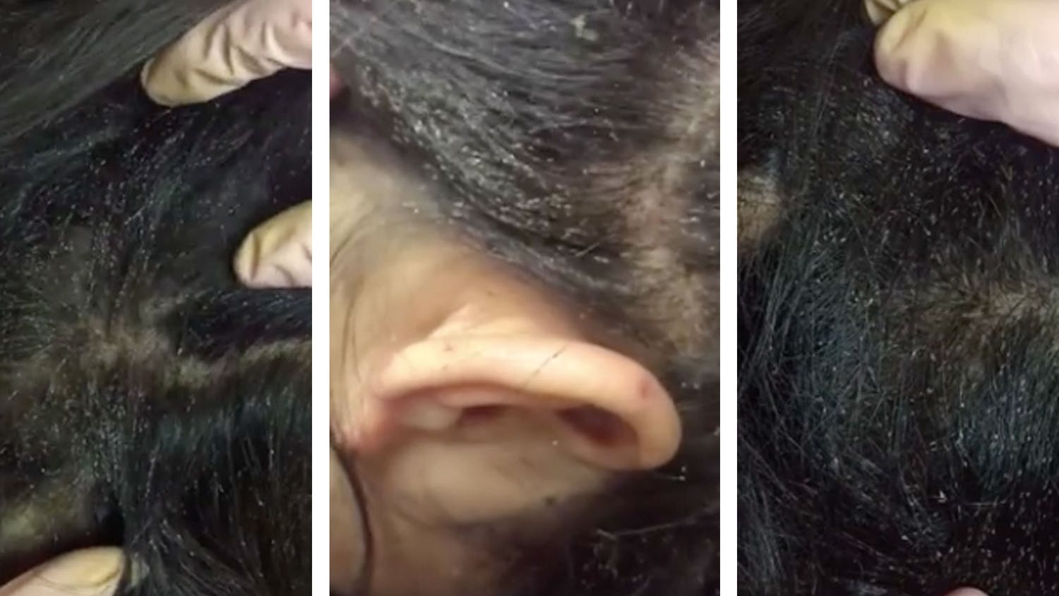 Mum Shares Video Of Daughter's Head Lice Infestation - Netmums