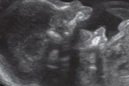 26 weeks pregnant scan