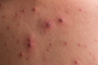 Chickenpox rash crusting over