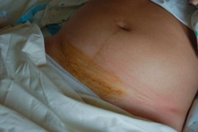 A c-section scar post-op