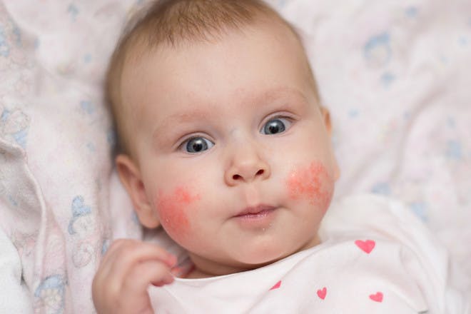 Baby with eczema patches on cheeks