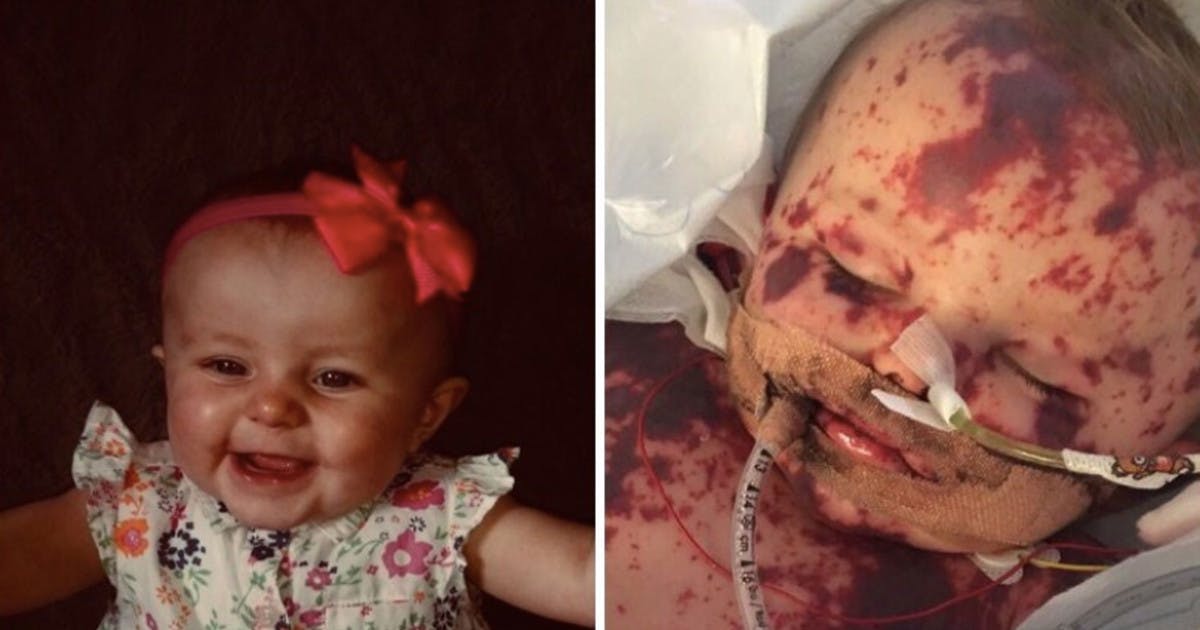 Baby With �Worst Case Of Meningitis Seen In Decades� Has