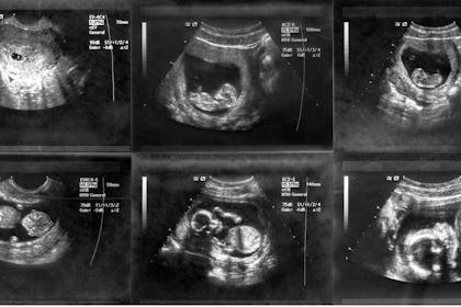 black and white ultrasound scan